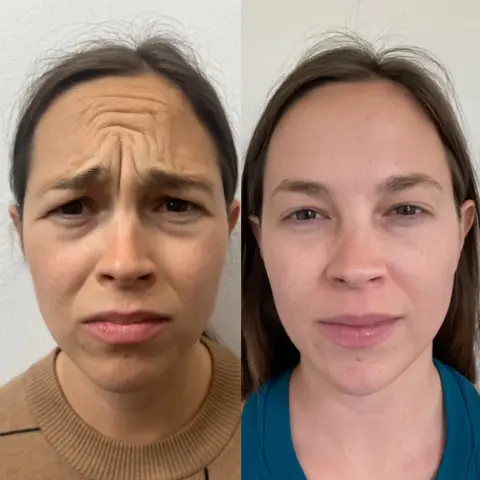 Before treatment - Forehead lines