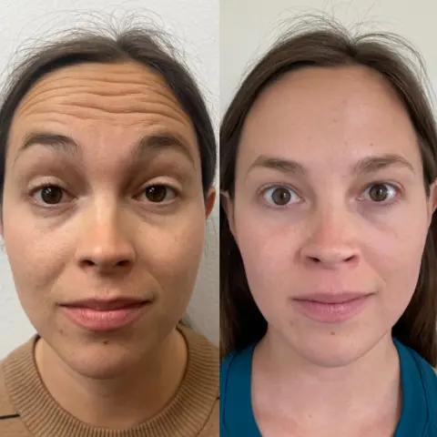 After treatment - Smooth forehead