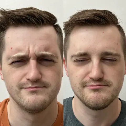 After treatment - Smooth forehead